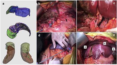 Successful Simultaneous Subtotal Splenectomy During Left Lobe Auxiliary Liver Transplantation for Portal Inflow Modulation and Severe Hypersplenism Correction: A Case Report